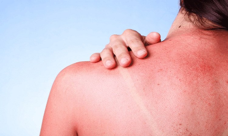 Sunburn Treatments: When the sun burns your soft skin, then try these tips to get relief in the problem of sunburn