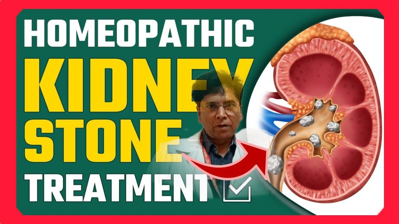 Kidney stones will be shattered and removed with homeopathy medicine