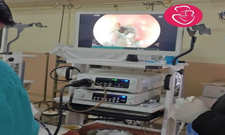 SNMC News: बैटरी सेल निगले से खाने के नली में अलसर (Ulcer in food pipe due to swallowing battery cell)