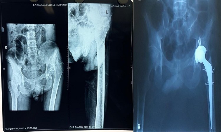 Complex Hip Surgery: पांच घंटे तक चली सर्जरी (Surgery lasted for five hours)